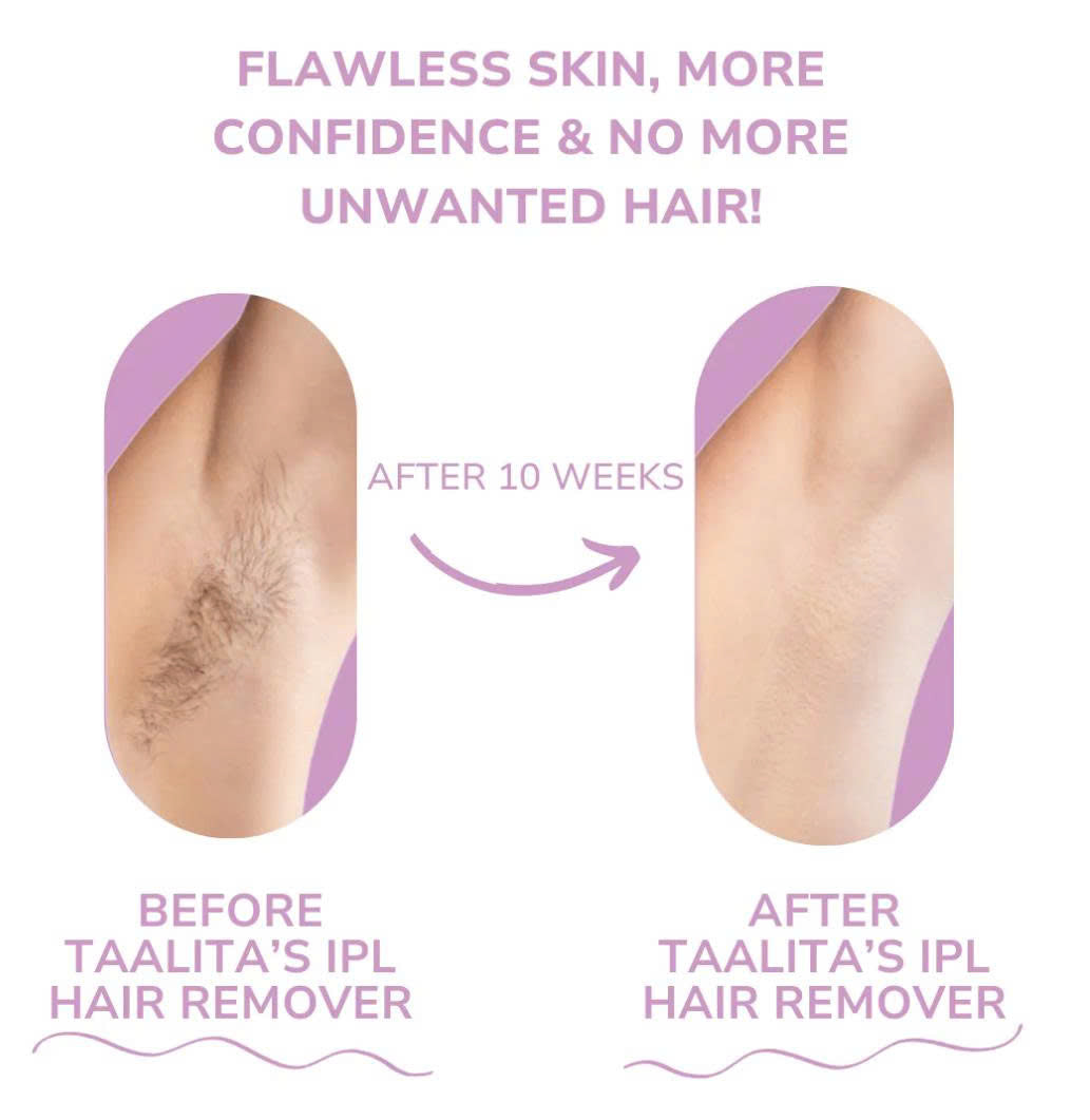 Home IPL Hair Removal β Pain-Free and Long-Lasting Results